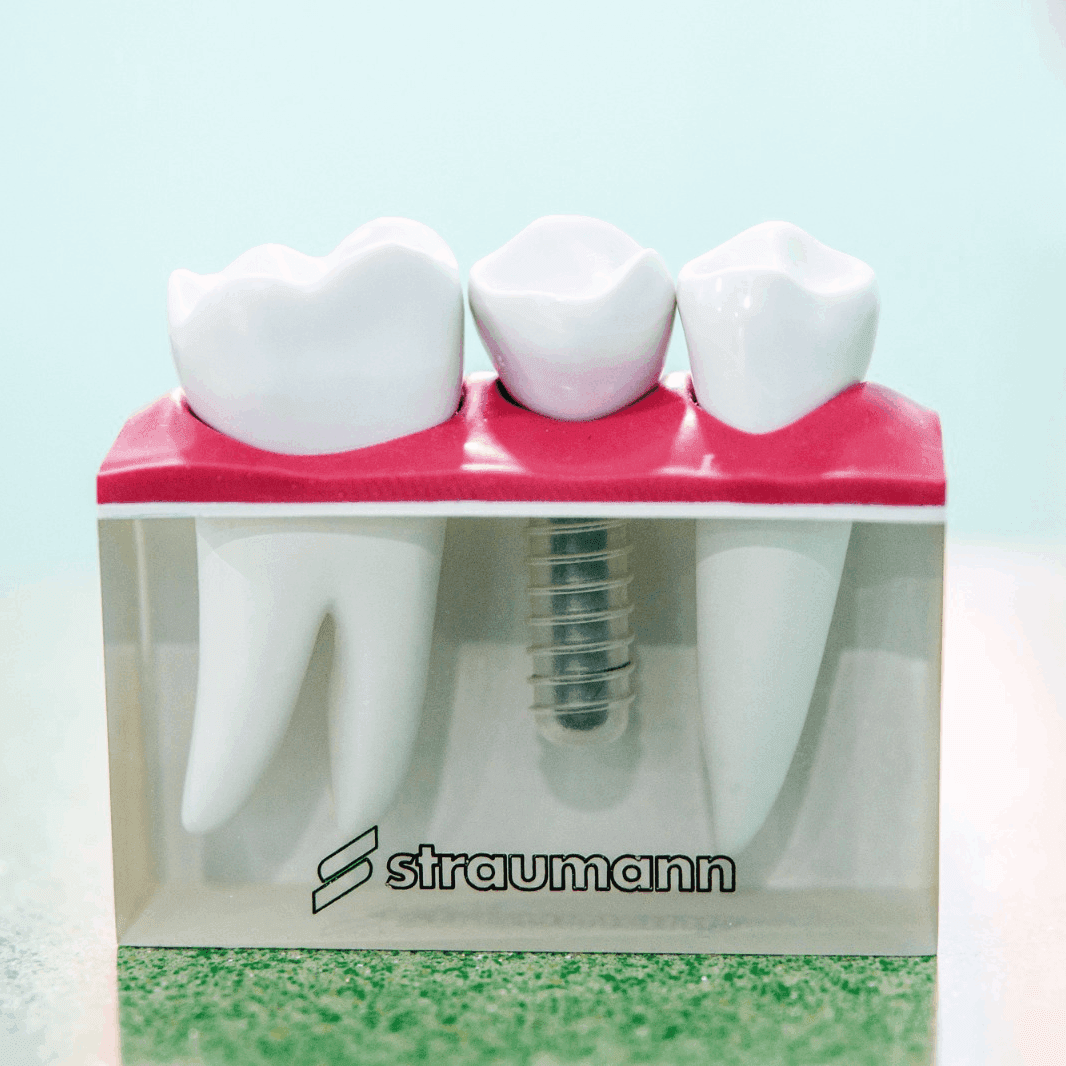 Teeth Implants